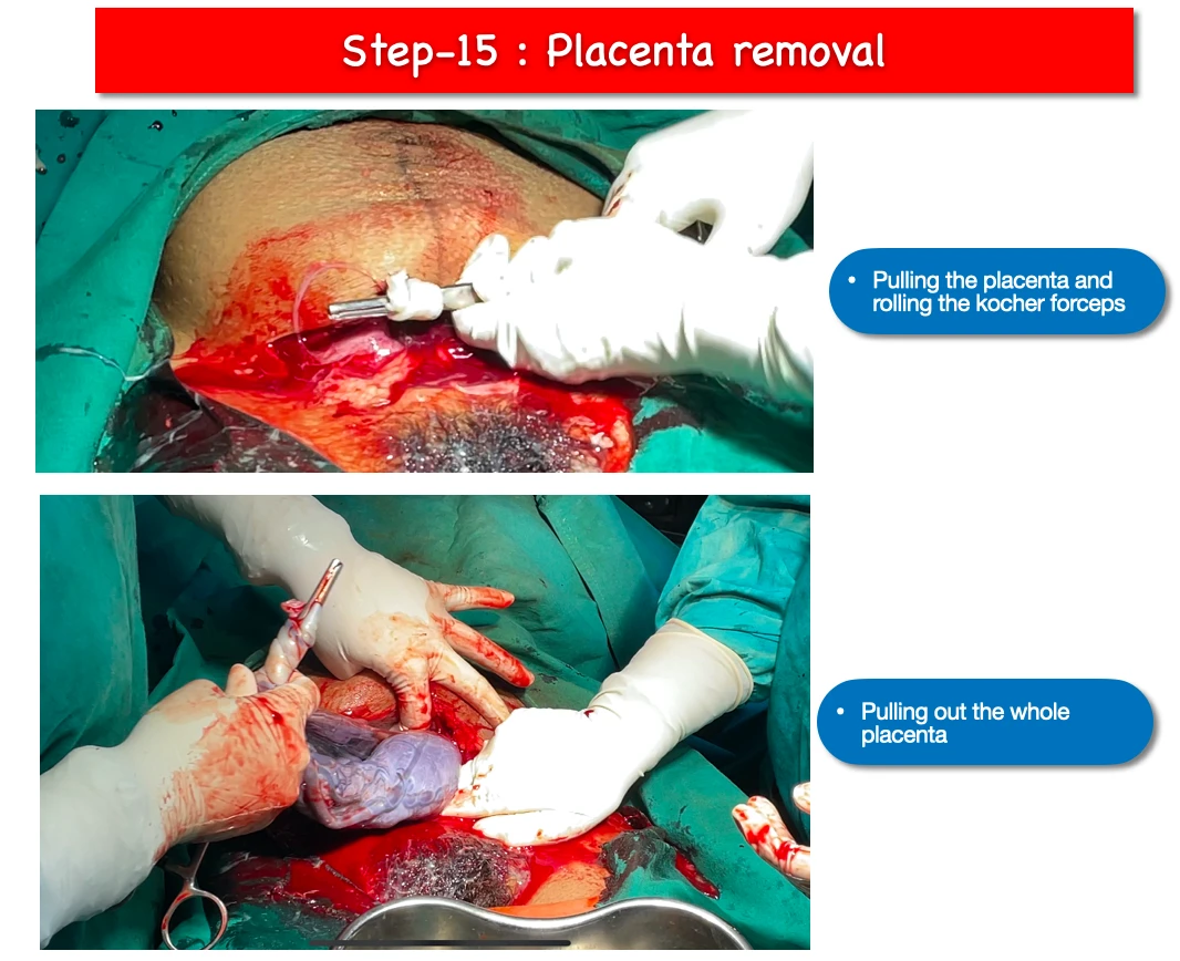 LSCS step 15